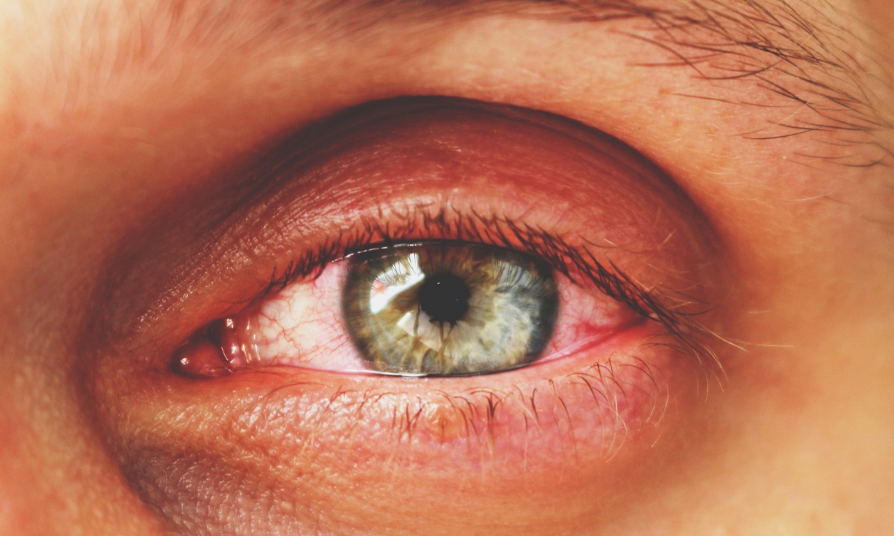 Вебинар для офтальмологов  «Схема лечения пациентов с заболеваниями глазной поверхности».
